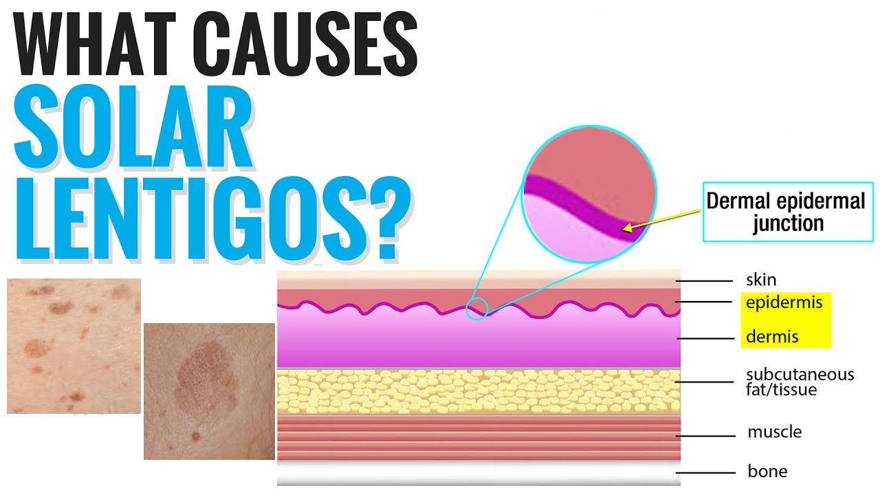 孚立美“氟轻松氢醌维A酸乳膏”能用于老年斑治疗吗？